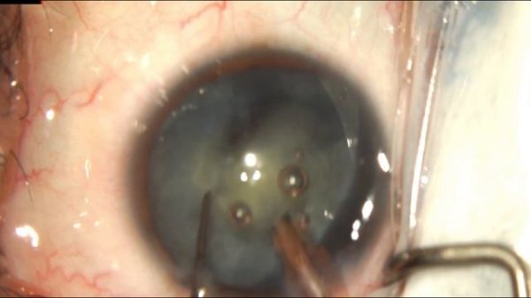 Intumescent Cataract, Momirhexis, Eyhance IOL, Centurion Vision System