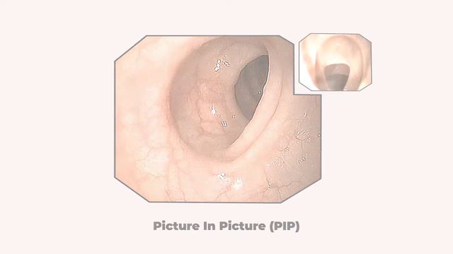 SmartEye-II Plus | HD Video Endoscopy System | Next Generation HD Video Endoscopy Experience смотреть онлайн