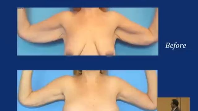 Arm Lift: Plastic Surgery after Weight Loss смотреть онлайн