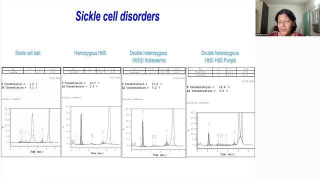 ISHBT Masterclass lecture on Interpretation of HPLC 10th Aug 2022 смотреть онлайн