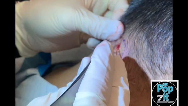 Firmly Packed Neck Cyst. Big Squeeze And Pop. Full Cyst Excision And Closure. MrPopZit.