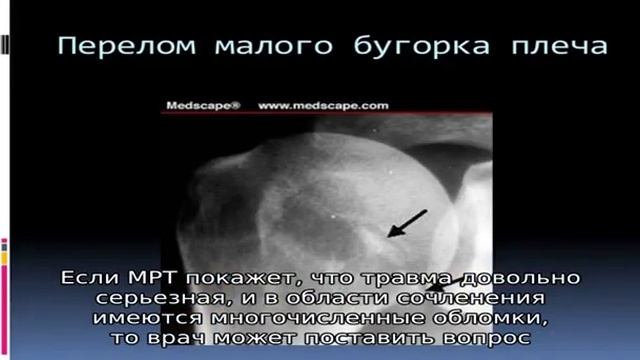 Перелом бугорка плечевой кости смотреть онлайн