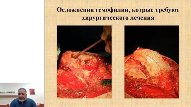 Наш досвід ендопротезування при важкій формі гемофілії. смотреть онлайн