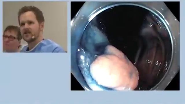 Polypectomy Of An Ileocecal Valve Adenoma