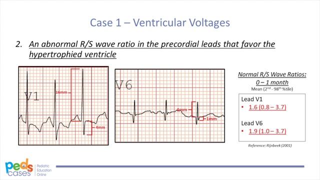 Approach to Pediatric ECGs (Part 2/2) смотреть онлайн