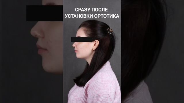 До и сразу после ортотика смотреть онлайн