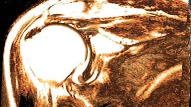 supraspinatus tear - 3D MRI finding смотреть онлайн