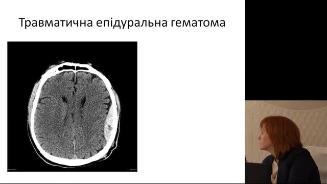 Променева діагностика екстрааксіальних ушкоджень черепа Агій В І , Ужгород смотреть онлайн