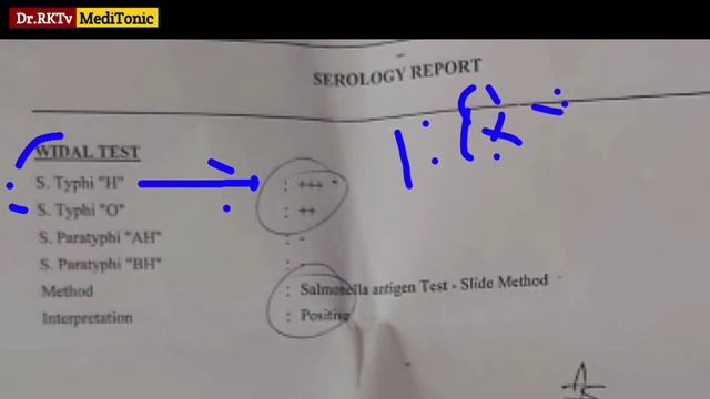Widal Test Reading In Hindi | Typhi O, Typhi H, Widal Test Positive & Negative | Widal Test Report смотреть онлайн