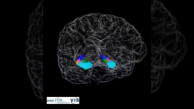 3D Hippocampus and Hippocampal Subfields of a Human Brain смотреть онлайн