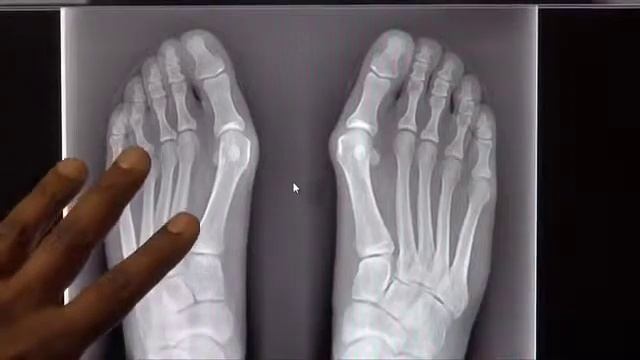 Dr. Mathew M. John Discusses Bunions on Trustdale TV. Dr. John is a Foot Surgeon / Podiatrist смотреть онлайн