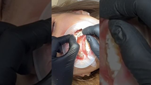 Как фиксируют брекеты? смотреть онлайн