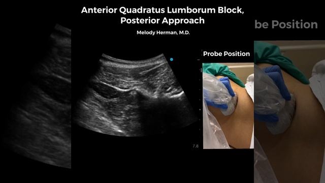 Anterior quadratus lumborum block, posterior approach смотреть онлайн