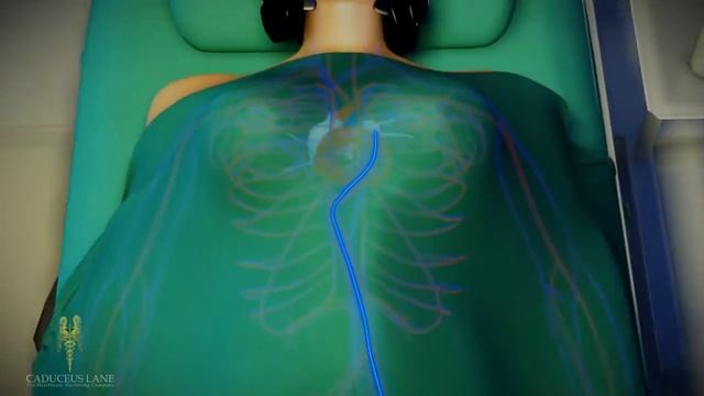 3D Medical Animation HD Arteriovenous Malformation Brain AVM смотреть онлайн