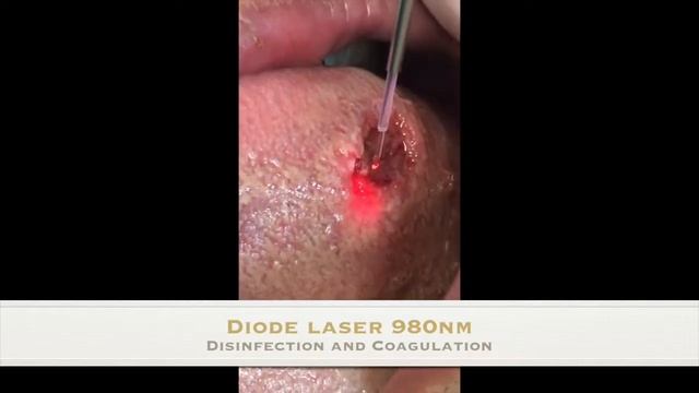 Laser-Excision of Sqaumous cell papilloma benign lesion смотреть онлайн