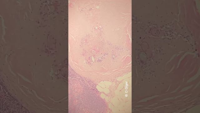 Schistosomiasis (S. Haematobium) in a mesenteric lymph node under the microscope смотреть онлайн