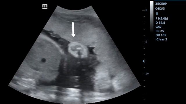 Ultrasound showing boy baby with umbilical cord around it's neck !!! смотреть онлайн