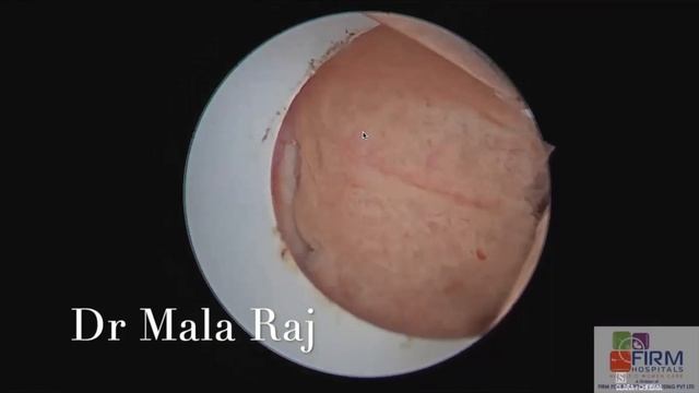 Bladder Endometriosis turned out to be Bladder Papilloma - Dr Mala Raj смотреть онлайн