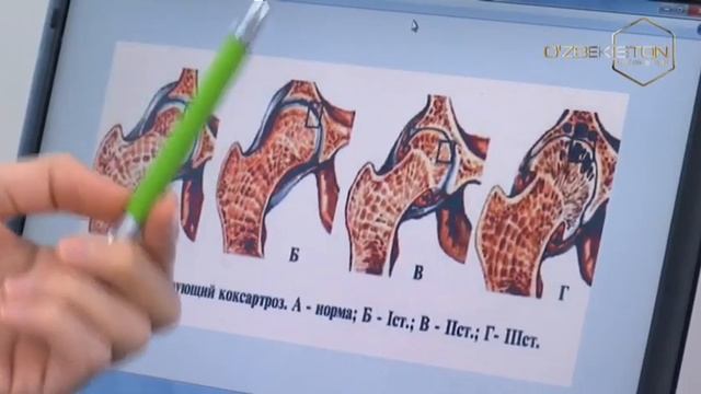 O`zingni angla | Koksartroz qanday kasallik, tashxis qo`yish va uning zamonaviy davolash usullari смотреть онлайн
