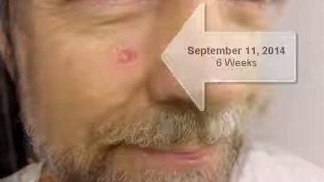 Curaderm Cure Of A BCC In 63 Days