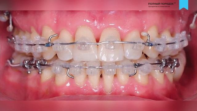 Перелечивание на цифровых брекетах INSIGNIA - прогресс за 2 года. смотреть онлайн