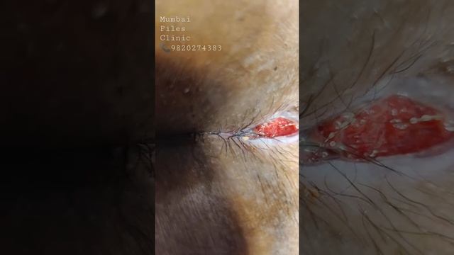Hyper Granulating Pilonidal sinus || SiLaC laser procedure || Dr Sambit Patnaik смотреть онлайн