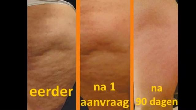 Bye Bye Cellulite NL смотреть онлайн