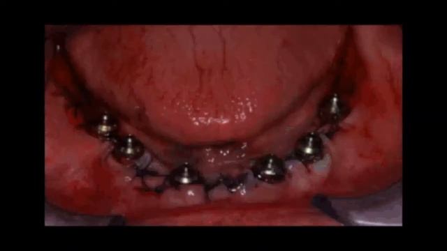 Implant TG beautiful смотреть онлайн