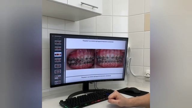 Гипертонус жевательных мышц смотреть онлайн