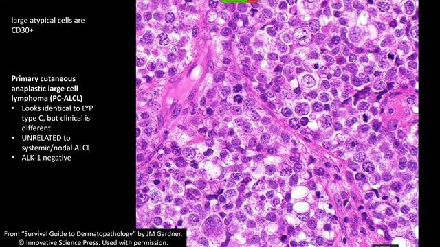 Anaplastic Large Cell Lymphoma & Lymphomatoid Papulosis: CD30 Positive Lymphoproliferative Disorder смотреть онлайн