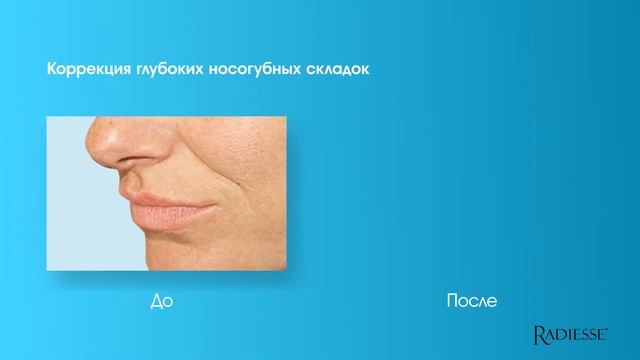 Radiesse MERZ WAITINGROOM TV 5 по Радиессу