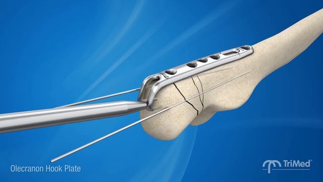 TriMed Olecranon Hook Plate - Rock Solid fixation for comminuted olecranon fractures смотреть онлайн