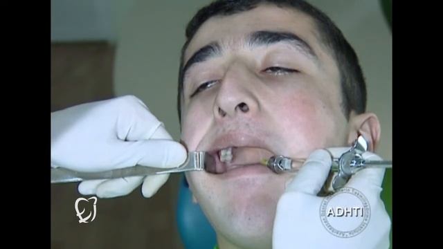 TORUSAL ANESTEZİYA смотреть онлайн