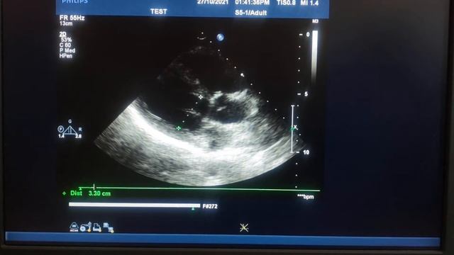 Пацієнтка з обривом хорд перед. стулки ТК смотреть онлайн