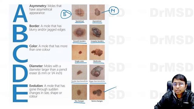 ABCDE | Diagnosing MELANOMA | Skin cancer | Breslow Thickness | Clark Level | Mason Fontana Stain | смотреть онлайн