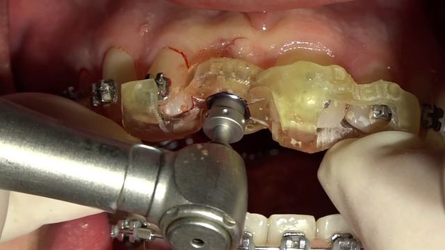 Cirurgia Guiada GM Clínica Dinato смотреть онлайн