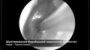 Шунтирование барабанной полости у ребенка с экссудативным отитом/ tympanostomy tube/ Камран Гаджие