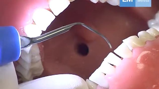 Use of piezo tip PE-40H смотреть онлайн