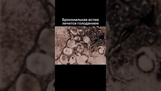 Бронхиальная астма смотреть онлайн