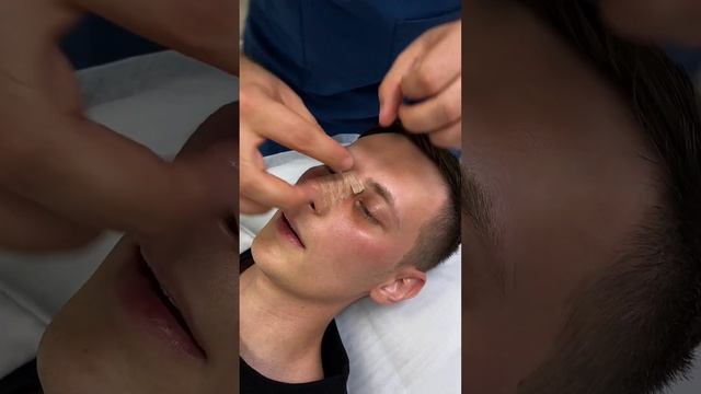Ринопластика: осмотр после пластики носа и перевязка смотреть онлайн