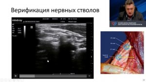 Блокада плечевого сплетения под УЗИ Лахин Р.Е.