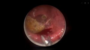 Аденокарцинома прямой кишки. Операция по удалению.