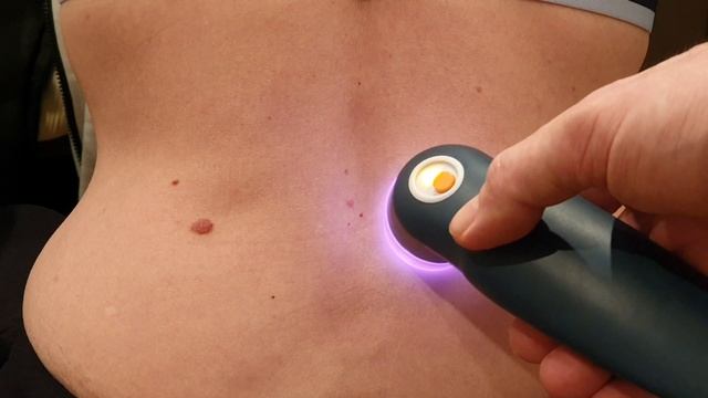 Lumbar spine low level laser for low back pain LLLT смотреть онлайн