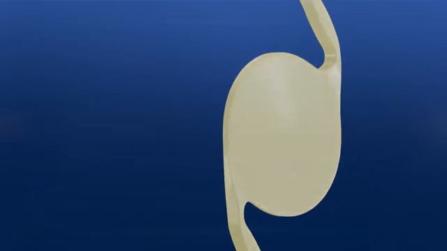 Alcon Vivity IOL Mechanism Of Action