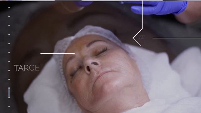 Plasma Pen Services | Allied Medical Aesthetics смотреть онлайн