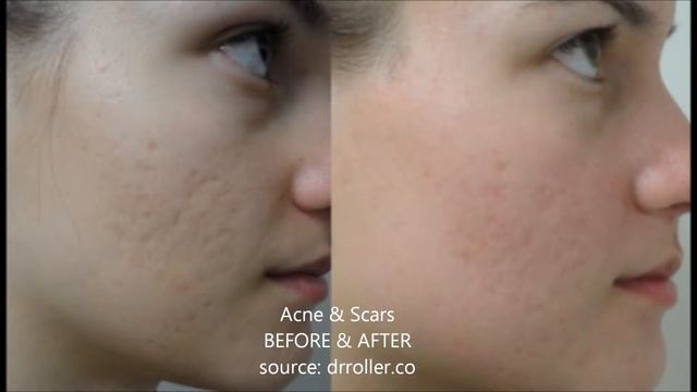 Derma Roller Skin Therapy System - Derma Roller Review смотреть онлайн