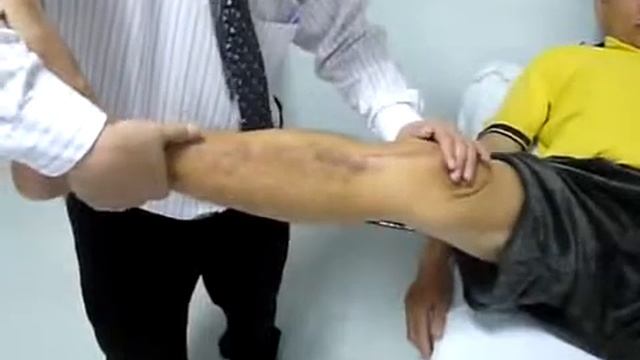 Реверсивный pivot shift тест смотреть онлайн