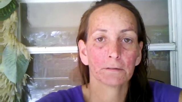Carac treatment Day 16. After washing off... смотреть онлайн