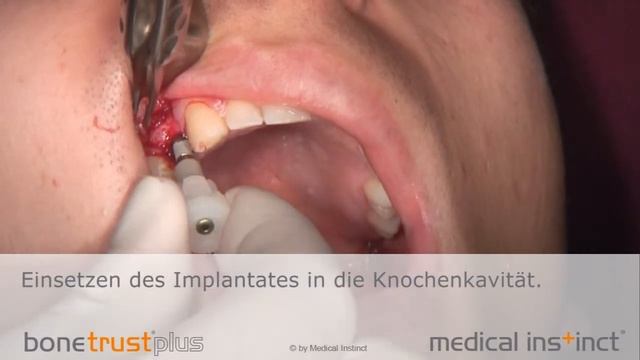 Implantation BoneTrust plus Implantat, Medical Instinct смотреть онлайн