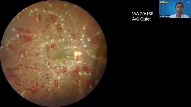 UVEITIS GRAND ROUND - 6 смотреть онлайн